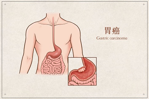 1657043293833817.jpg 攝圖網_401789678_胃癌醫(yī)療插畫(企業(yè)商用).jpg