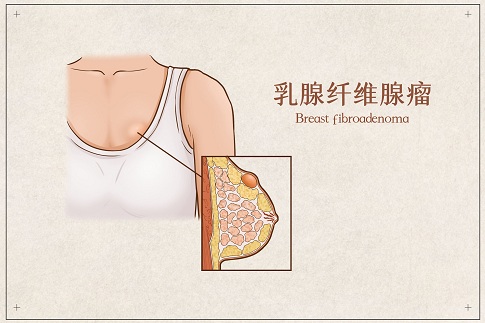 1659196941381671.jpg 攝圖網(wǎng)_401789492_banner_乳腺纖維腺瘤醫(yī)療插畫(huà)示意圖(企業(yè)商用).jpg