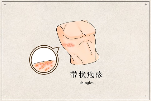 1659282562432061.jpg 攝圖網_401789790_帶狀皰疹醫(yī)療插畫(企業(yè)商用).jpg